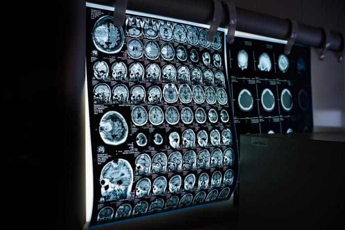 Dosud neexistují laboratorní nebo zobrazovací metody pro diagnostiku schizofrenie. Změnit to chce projekt BRAINSCAPE